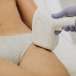 Laser epilation
